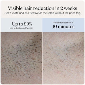 SmoothSkin Pure Fit IPL hair removal - image 4