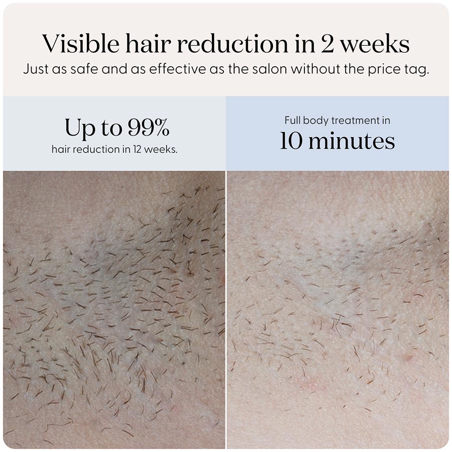 SmoothSkin Pure Fit IPL hair removal - image 4